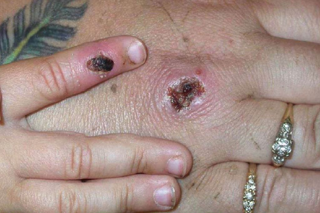 Two Monkeypox cases discovered in UK – New York Post